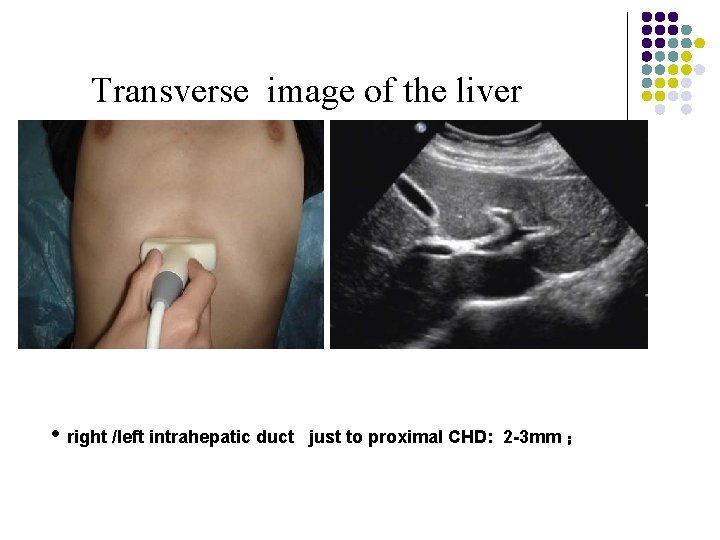 Transverse image of the liver • right /left intrahepatic duct just to proximal CHD: