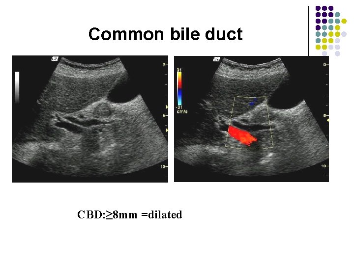 Common bile duct CBD: ≥ 8 mm =dilated 