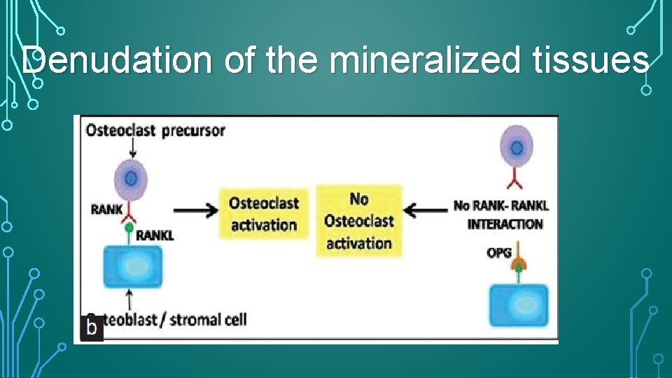Denudation of the mineralized tissues 