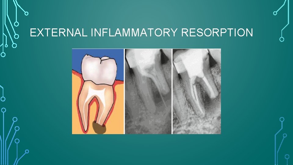 EXTERNAL INFLAMMATORY RESORPTION 