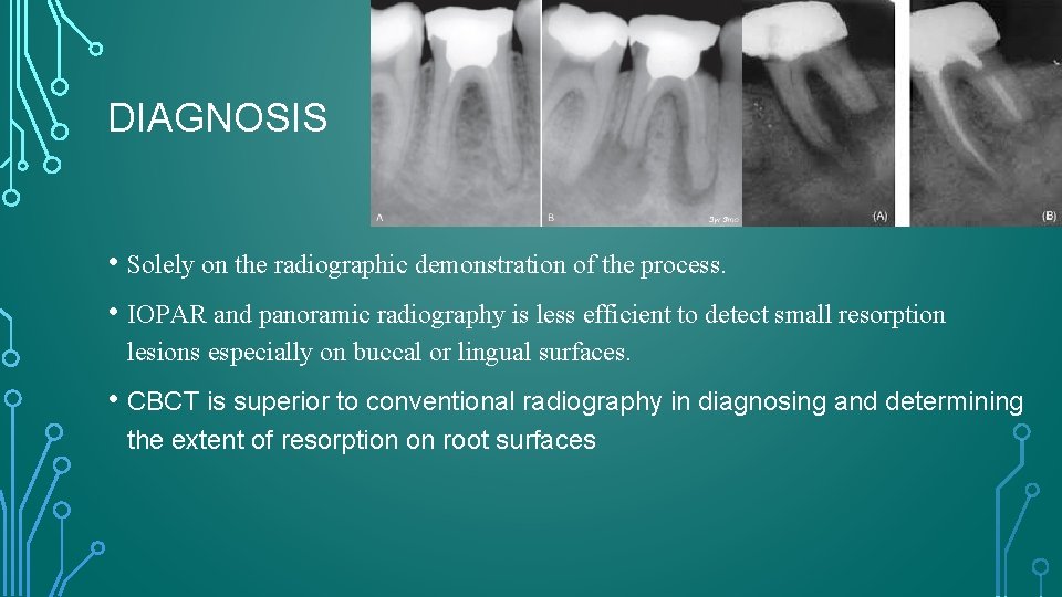 DIAGNOSIS • Solely on the radiographic demonstration of the process. • IOPAR and panoramic