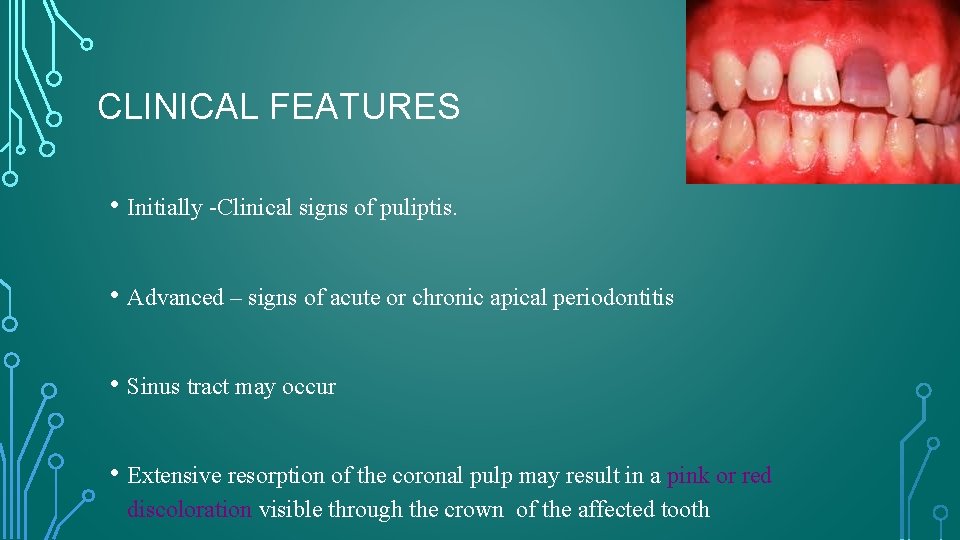 CLINICAL FEATURES • Initially -Clinical signs of puliptis. • Advanced – signs of acute