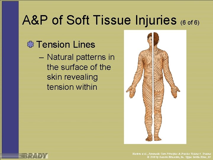 A&P of Soft Tissue Injuries (6 of 6) Tension Lines – Natural patterns in
