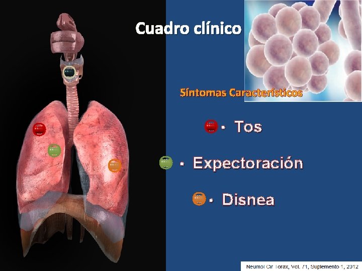 Cuadro clínico Síntomas Característicos • Tos • Expectoración • Disnea 