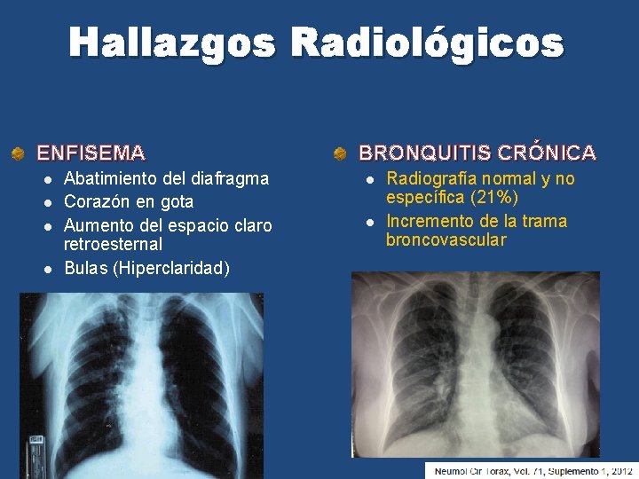 Hallazgos Radiológicos ENFISEMA l l Abatimiento del diafragma Corazón en gota Aumento del espacio
