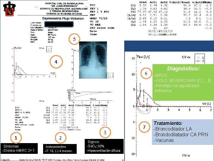 5 4 6 Diagnóstico: -EPOC -GOLD SEVERO III/IV (C)…. B -Fenotipo no agudizador enfisema