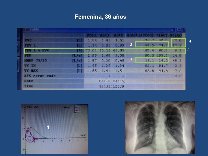 Femenina, 86 años 3 4 2 3 1 