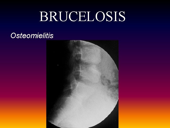 BRUCELOSIS Osteomielitis BRUCELOSIS Osteomielitis
