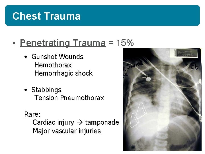 Chest Trauma • Penetrating Trauma = 15% • Gunshot Wounds Hemothorax Hemorrhagic shock • Chest Trauma • Penetrating Trauma = 15% • Gunshot Wounds Hemothorax Hemorrhagic shock •
