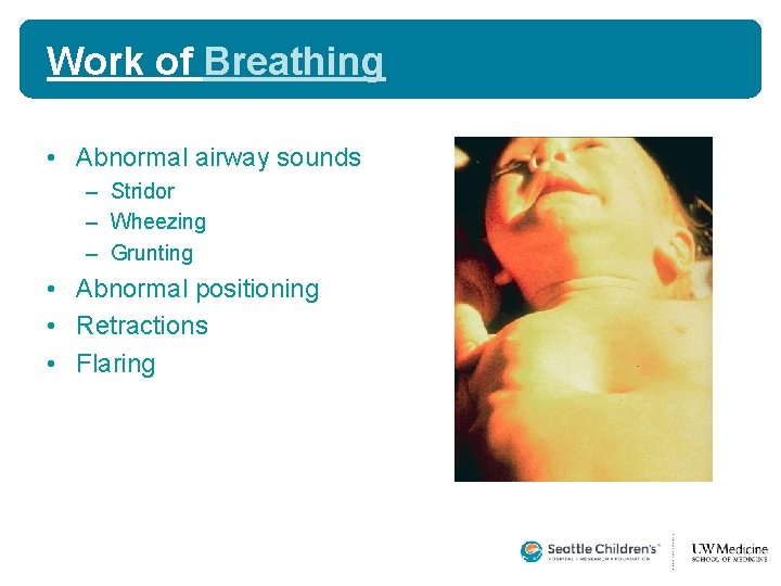 Work of Breathing • Abnormal airway sounds – Stridor – Wheezing – Grunting • Work of Breathing • Abnormal airway sounds – Stridor – Wheezing – Grunting •