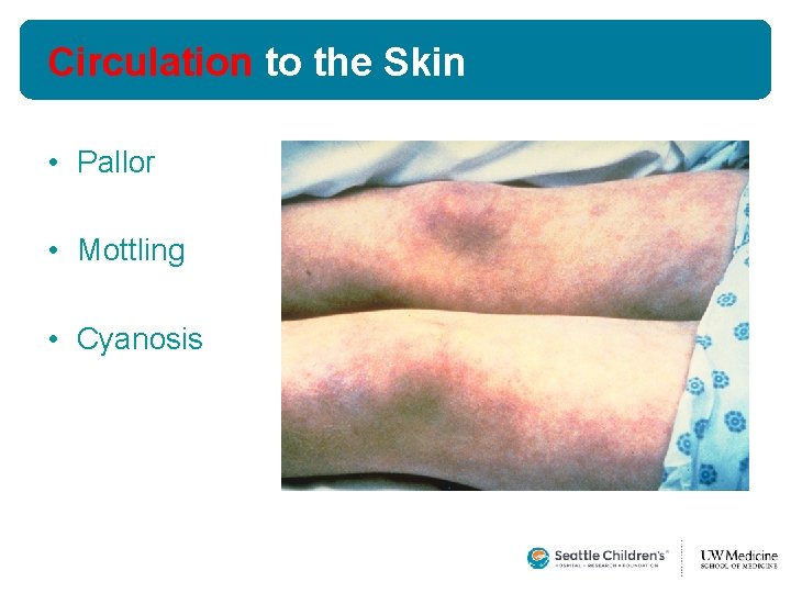 Circulation to the Skin • Pallor • Mottling • Cyanosis  Circulation to the Skin • Pallor • Mottling • Cyanosis