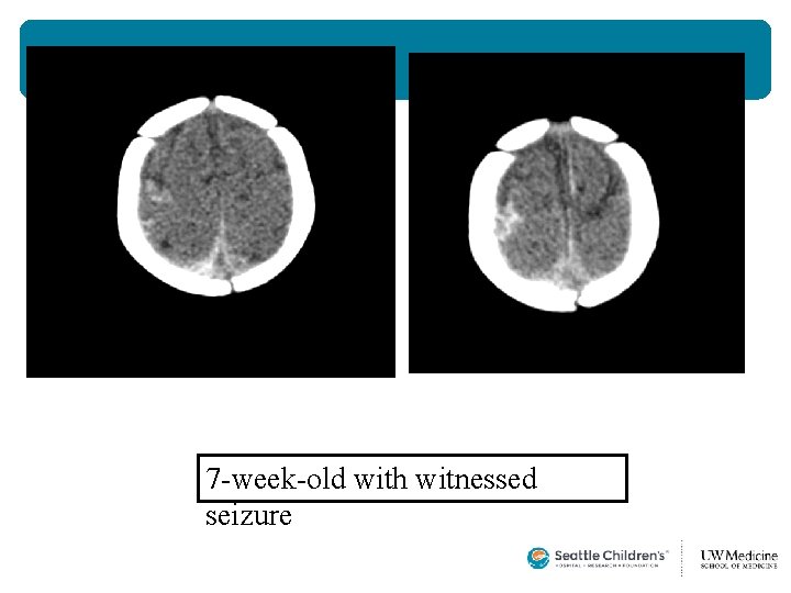 7 -week-old with witnessed seizure  7 -week-old with witnessed seizure