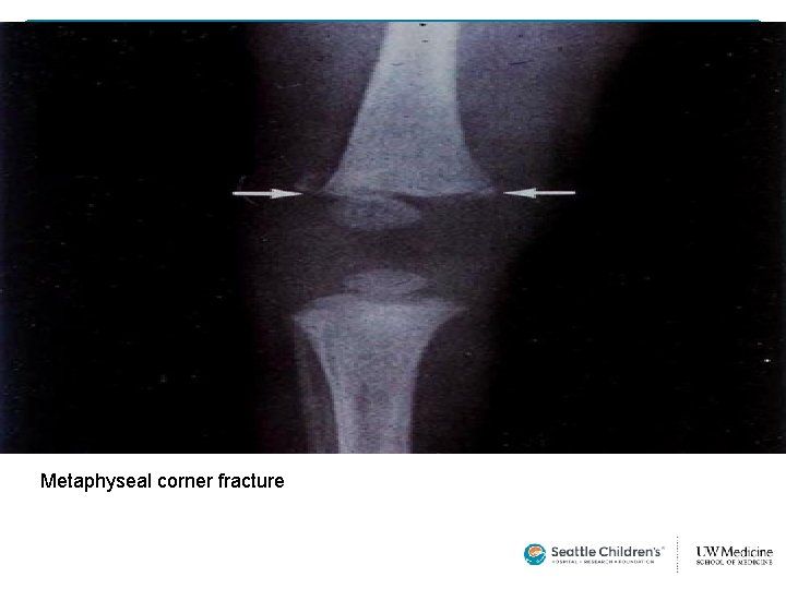 Metaphyseal corner fracture  Metaphyseal corner fracture
