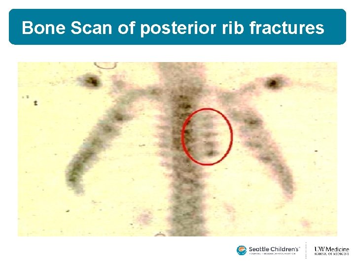 Bone Scan of posterior rib fractures  Bone Scan of posterior rib fractures