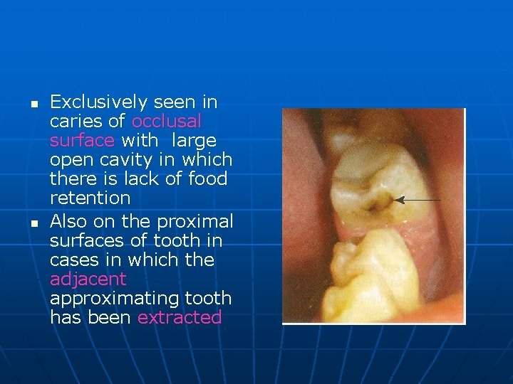 n n Exclusively seen in caries of occlusal surface with large open cavity in