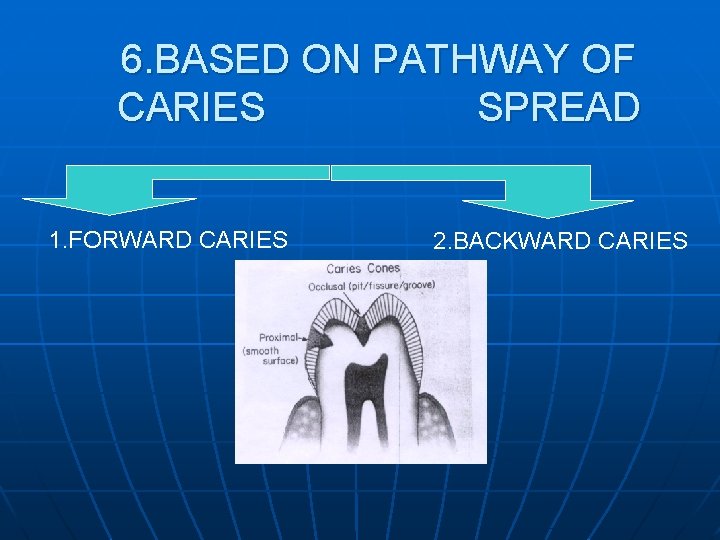 6. BASED ON PATHWAY OF CARIES SPREAD 1. FORWARD CARIES 2. BACKWARD CARIES 