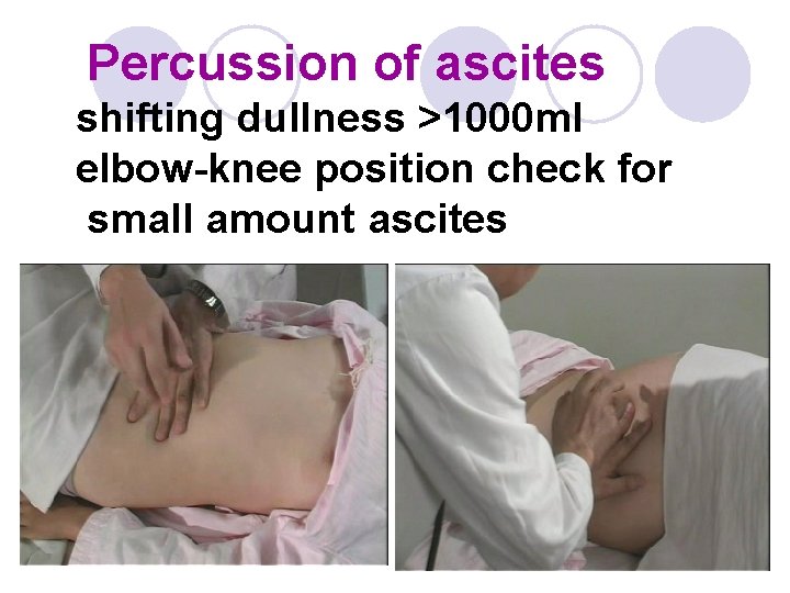 Percussion of ascites shifting dullness >1000 ml elbow-knee position check for small amount ascites