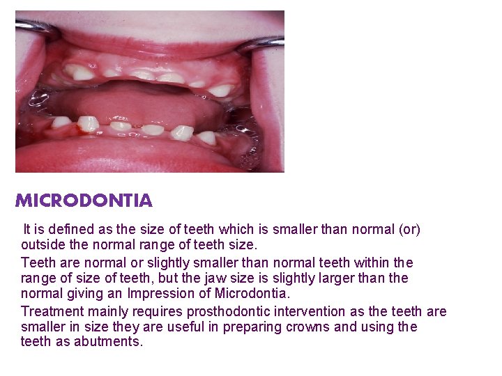 MICRODONTIA It is defined as the size of teeth which is smaller than normal