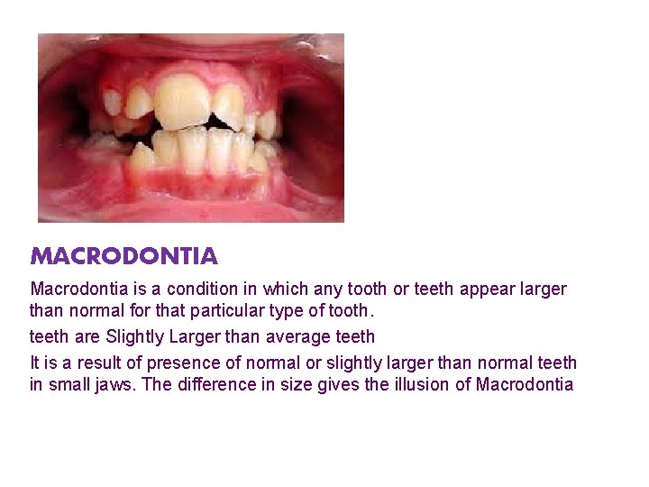 MACRODONTIA Macrodontia is a condition in which any tooth or teeth appear larger than