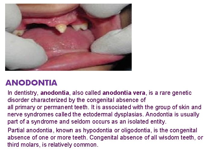 ANODONTIA In dentistry, anodontia, also called anodontia vera, is a rare genetic disorder characterized