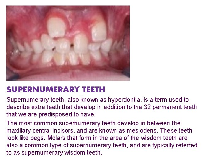 SUPERNUMERARY TEETH Supernumerary teeth, also known as hyperdontia, is a term used to describe