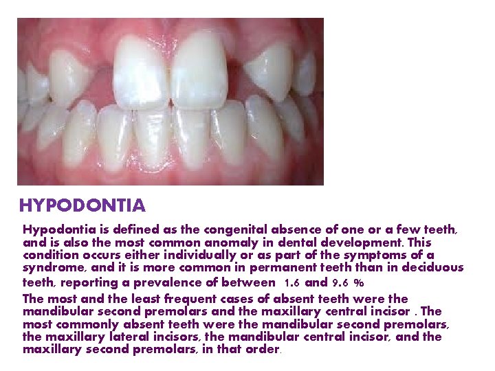 HYPODONTIA Hypodontia is defined as the congenital absence of one or a few teeth,