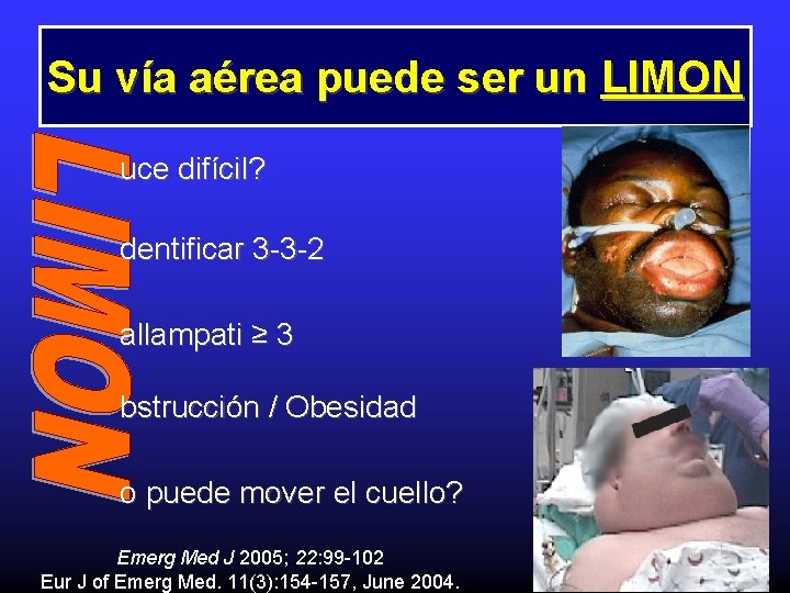 Su vía aérea puede ser un LIMON uce difícil? dentificar 3 -3 -2 allampati