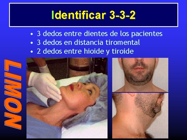 Identificar 3 -3 -2 • 3 dedos entre dientes de los pacientes • 3