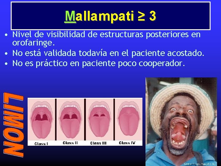 Mallampati ≥ 3 • Nivel de visibilidad de estructuras posteriores en orofaringe. • No