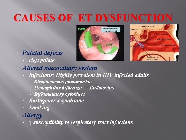CAUSES OF ET DYSFUNCTION � Palatal defects • � cleft palate Altered mucociliary system