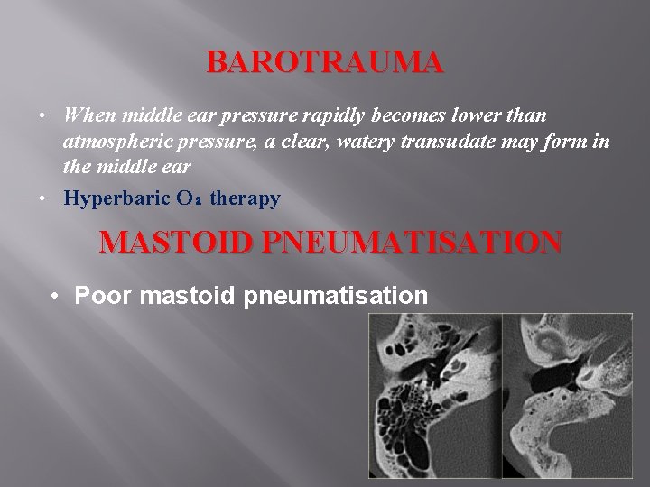 BAROTRAUMA When middle ear pressure rapidly becomes lower than atmospheric pressure, a clear, watery