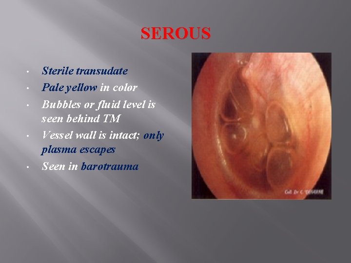 SEROUS • • • Sterile transudate Pale yellow in color Bubbles or fluid level SEROUS • • • Sterile transudate Pale yellow in color Bubbles or fluid level