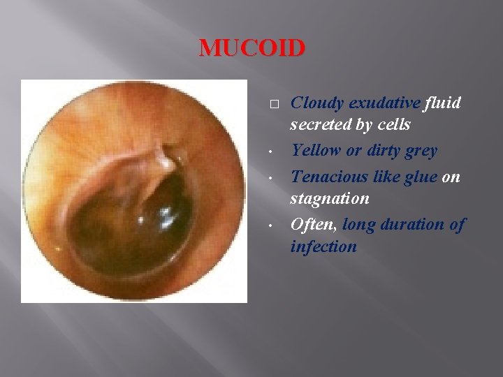 MUCOID � • • • Cloudy exudative fluid secreted by cells Yellow or dirty