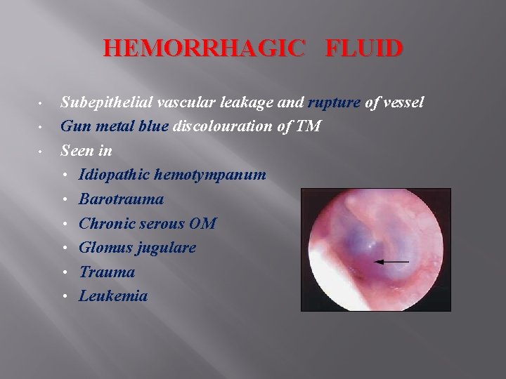 HEMORRHAGIC FLUID • • • Subepithelial vascular leakage and rupture of vessel Gun metal HEMORRHAGIC FLUID • • • Subepithelial vascular leakage and rupture of vessel Gun metal