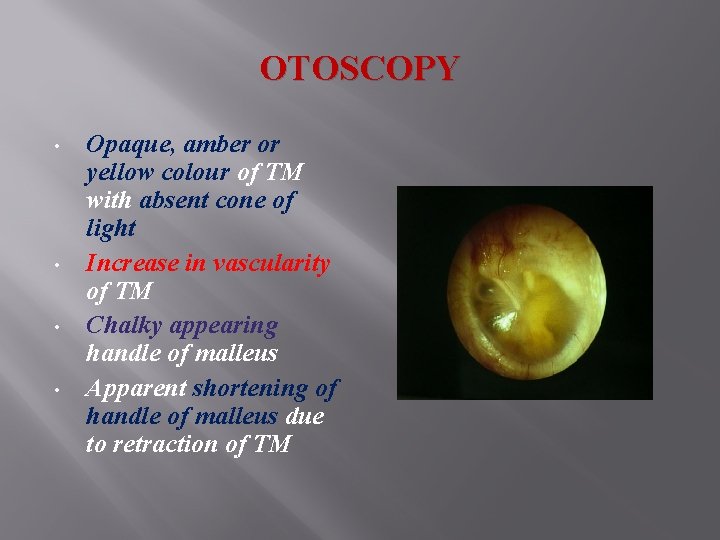 OTOSCOPY • • Opaque, amber or yellow colour of TM with absent cone of