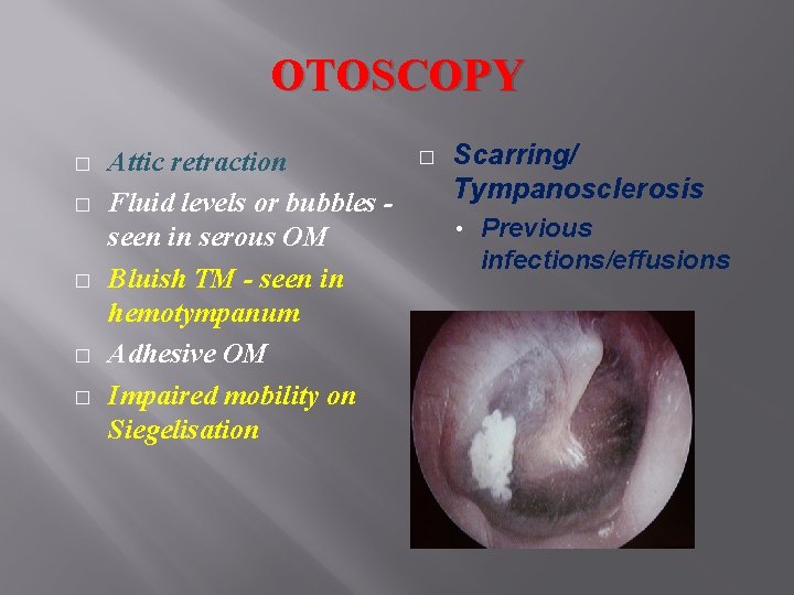 Otitis Media With Effusion Tuberculous Otitis Media Tympanosclerosis Otitis Media With Effusion Tuberculous Otitis Media Tympanosclerosis