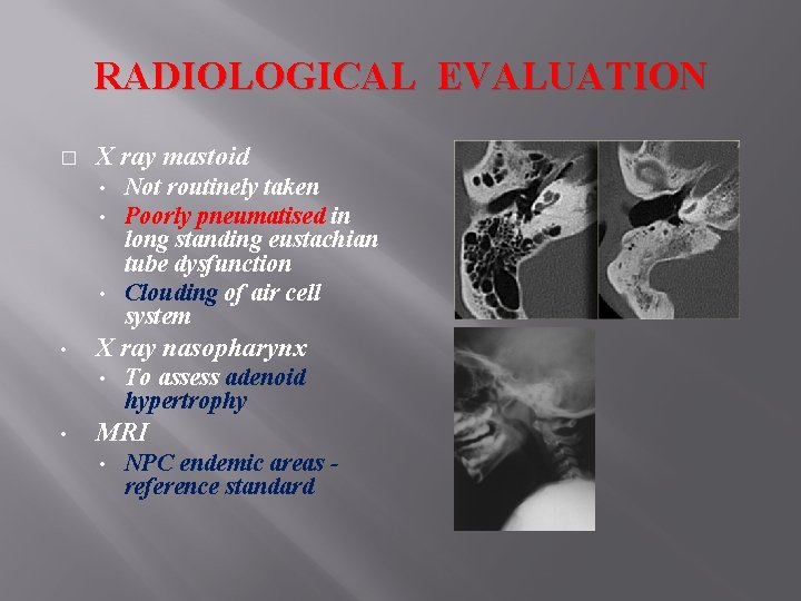 RADIOLOGICAL EVALUATION � X ray mastoid Not routinely taken Poorly pneumatised in long standing