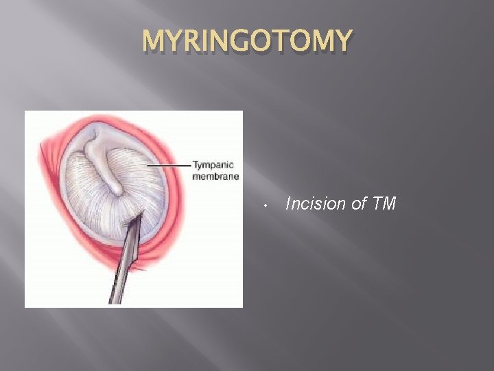 MYRINGOTOMY • Incision of TM 