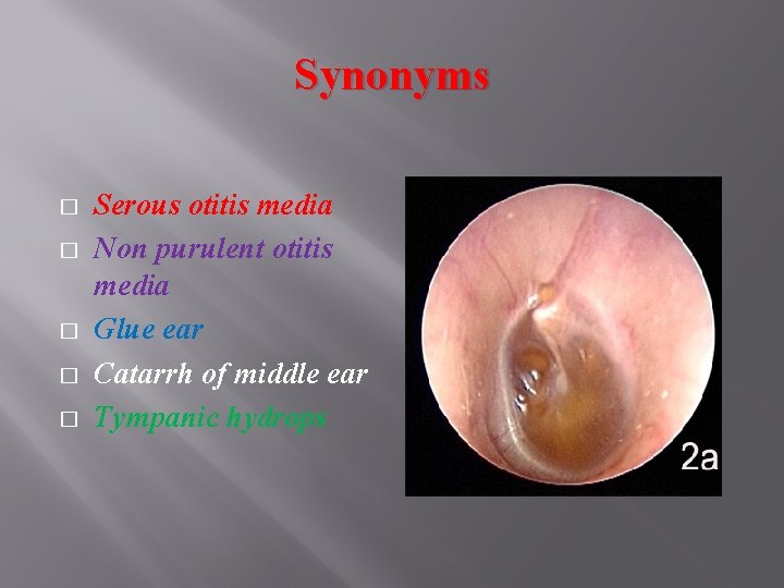 Synonyms � � � Serous otitis media Non purulent otitis media Glue ear Catarrh Synonyms � � � Serous otitis media Non purulent otitis media Glue ear Catarrh