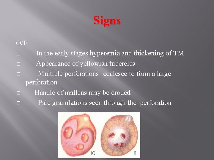 Signs O/E � � � In the early stages hyperemia and thickening of TM