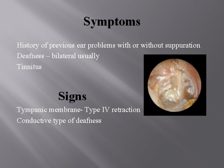 Symptoms History of previous ear problems with or without suppuration Deafness – bilateral usually Symptoms History of previous ear problems with or without suppuration Deafness – bilateral usually