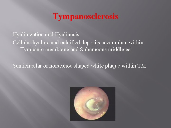Tympanosclerosis Hyalinization and Hyalinosis Cellular hyaline and calcified deposits accumulate within Tympanic membrane and