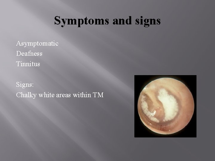 Symptoms and signs Asymptomatic Deafness Tinnitus Signs: Chalky white areas within TM 