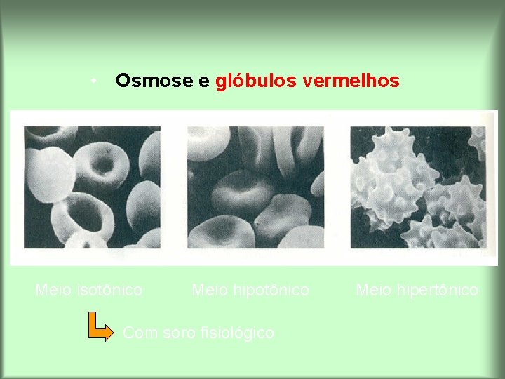  • Osmose e glóbulos vermelhos Meio isotônico Meio hipotônico Com soro fisiológico Meio