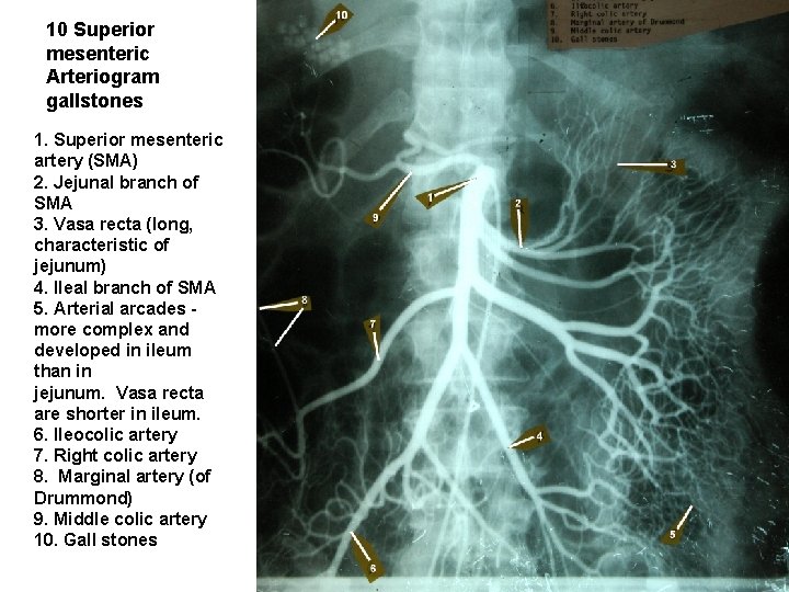 10 Superior mesenteric Arteriogram gallstones 1. Superior mesenteric artery (SMA) 2. Jejunal branch of