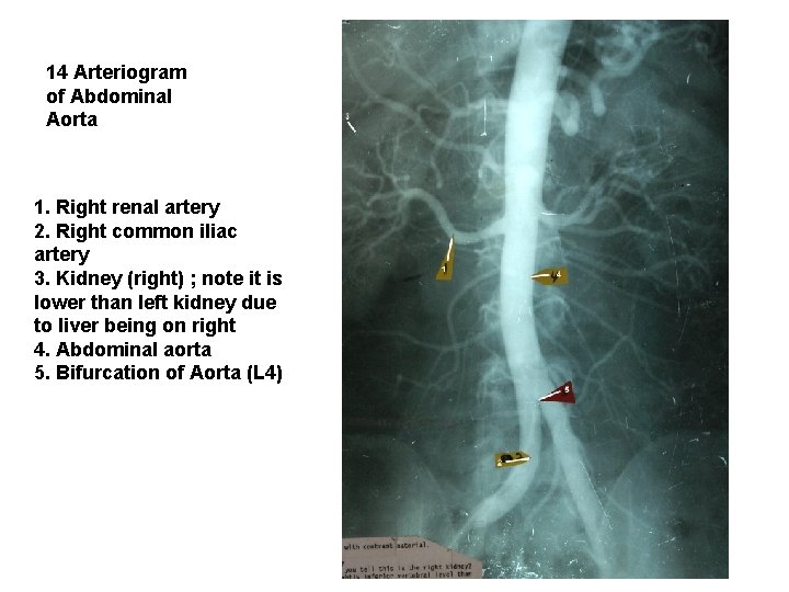 14 Arteriogram of Abdominal Aorta 1. Right renal artery 2. Right common iliac artery