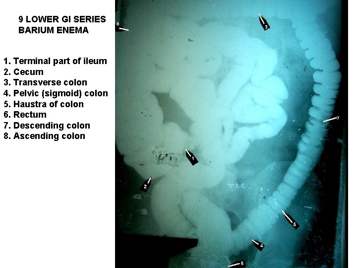 9 LOWER GI SERIES BARIUM ENEMA 1. Terminal part of ileum 2. Cecum 3.