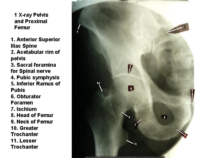 1 X-ray Pelvis and Proximal Femur 1. Anterior Superior Iliac Spine 2. Acetabular rim