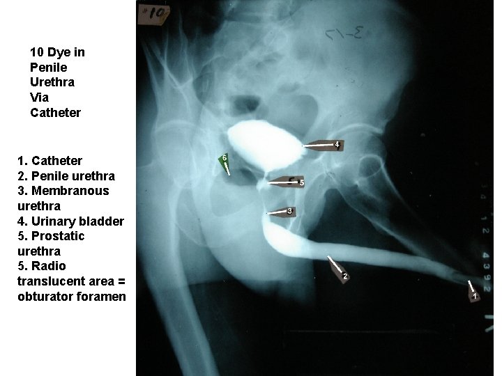 10 Dye in Penile Urethra Via Catheter 1. Catheter 2. Penile urethra 3. Membranous