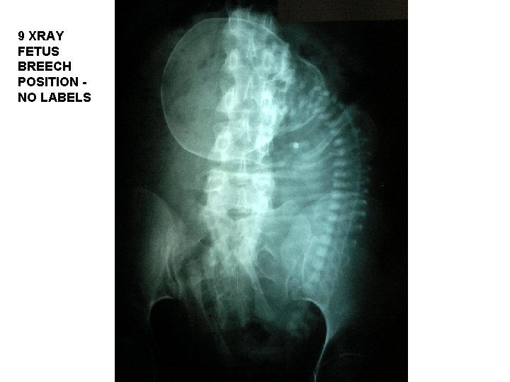 9 XRAY FETUS BREECH POSITION NO LABELS 